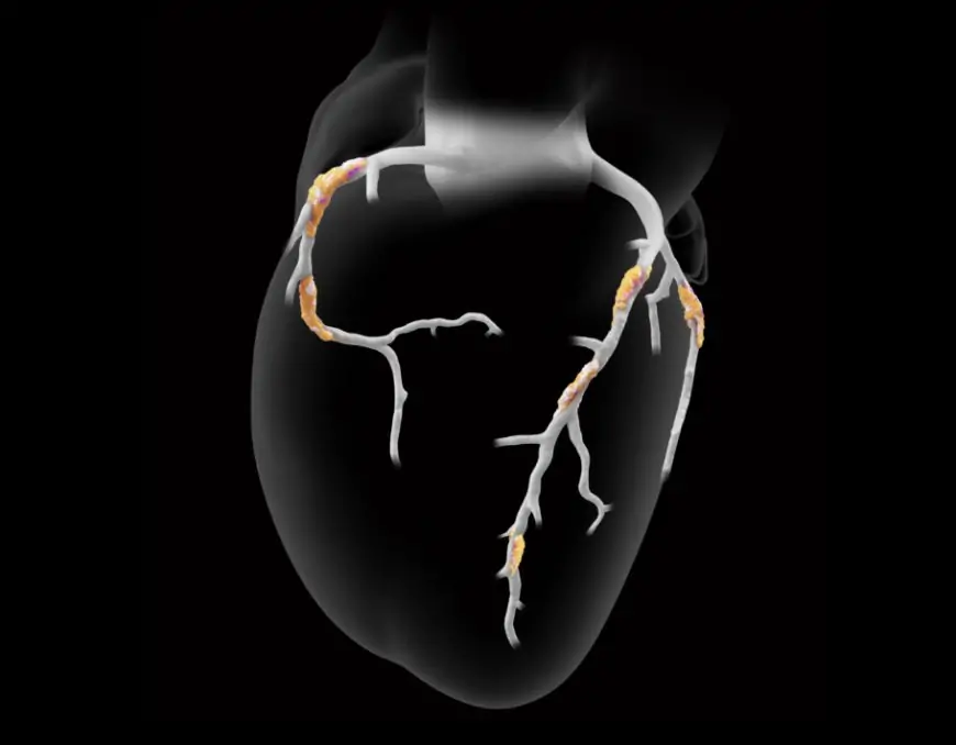 Heartflow, Inc. Announces Late-Breaking Data Validating AI-Driven Plaque Analysis for Coronary Risk